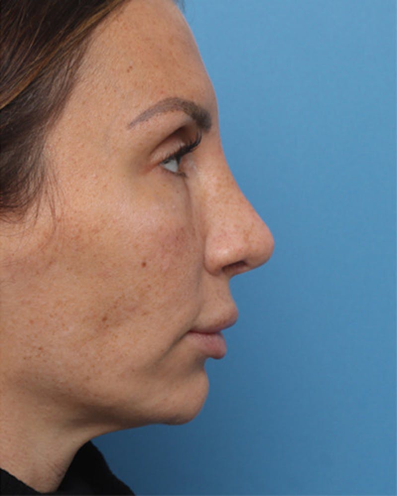 Revision Rhinoplasty Before & After Gallery - Patient 180542 - Image 2