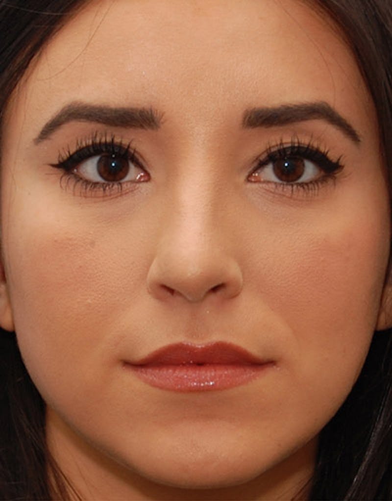 Foundation Rhinoplasty / Crooked Nose Before & After Gallery - Patient 274082 - Image 2