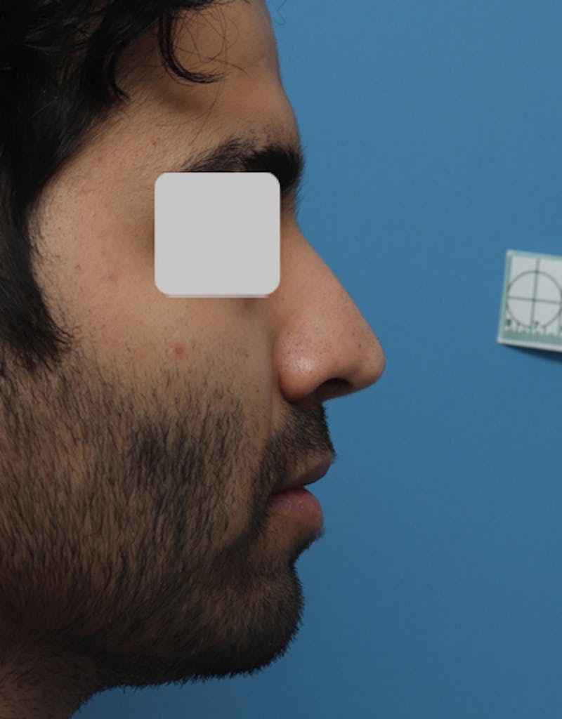 Ethnic Rhinoplasty Before & After Gallery - Patient 346298 - Image 2