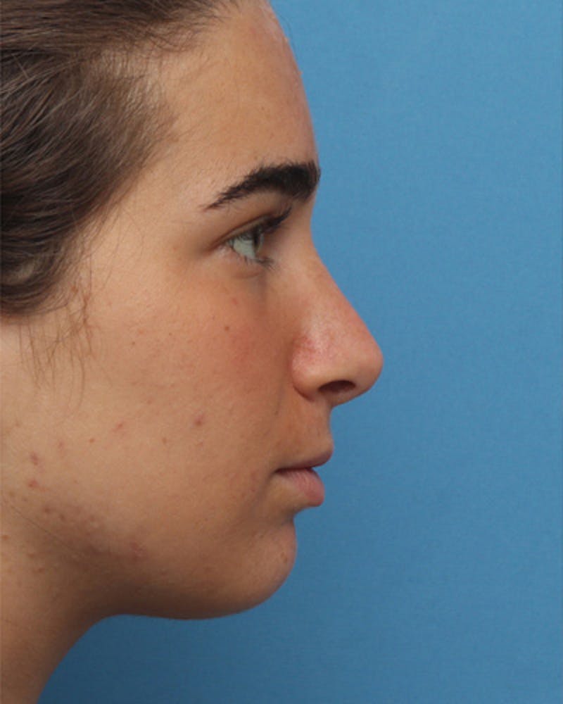 Rhinoplasty Before & After Gallery - Patient 345096 - Image 2