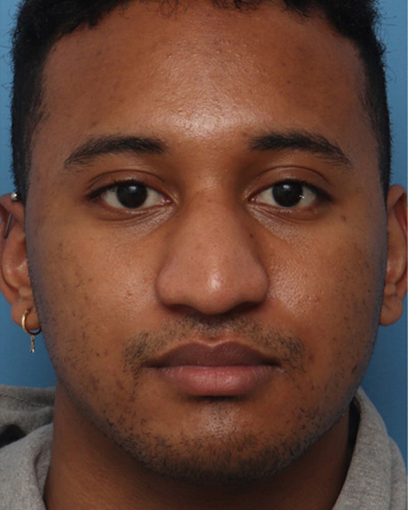 Rhinoplasty  Before & After Gallery - Patient 193191 - Image 3