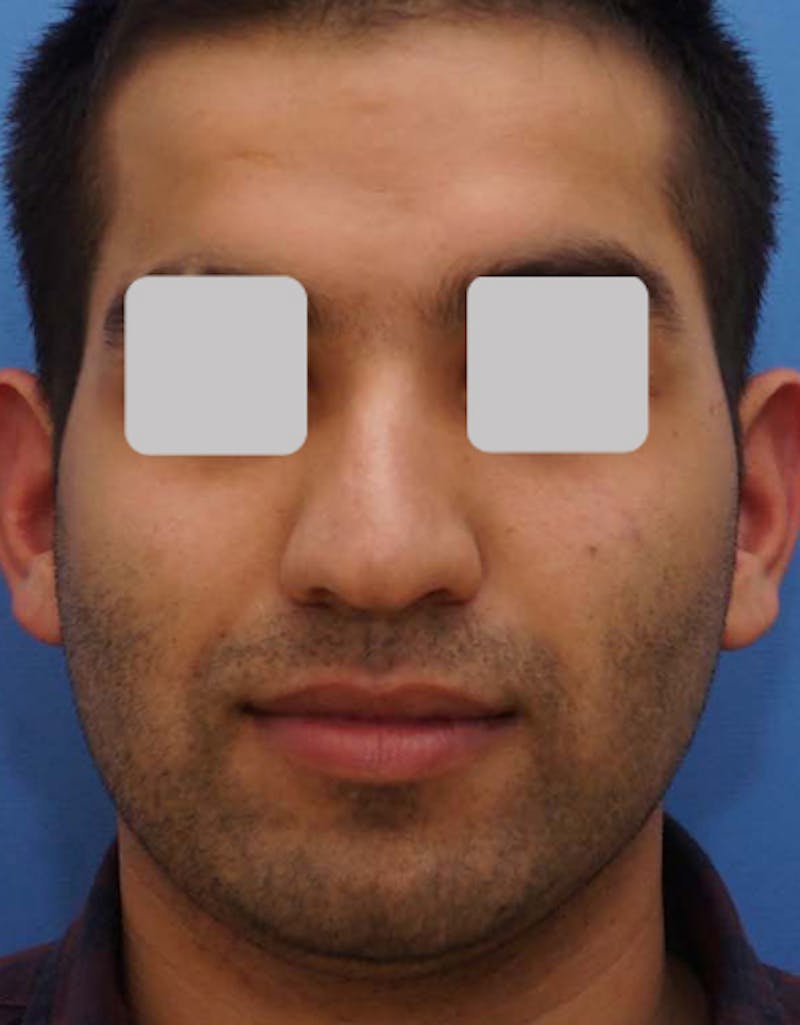 Ethnic Rhinoplasty Before & After Gallery - Patient 346298 - Image 3