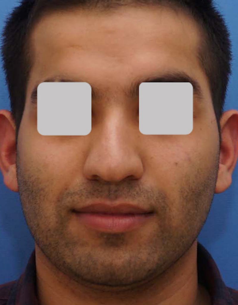 Rhinoplasty  Before & After Gallery - Patient 241410 - Image 3