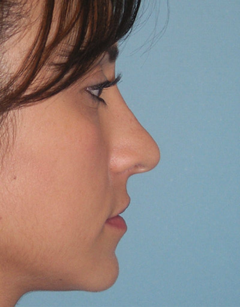 Foundation Rhinoplasty / Crooked Nose Before & After Gallery - Patient 274082 - Image 3