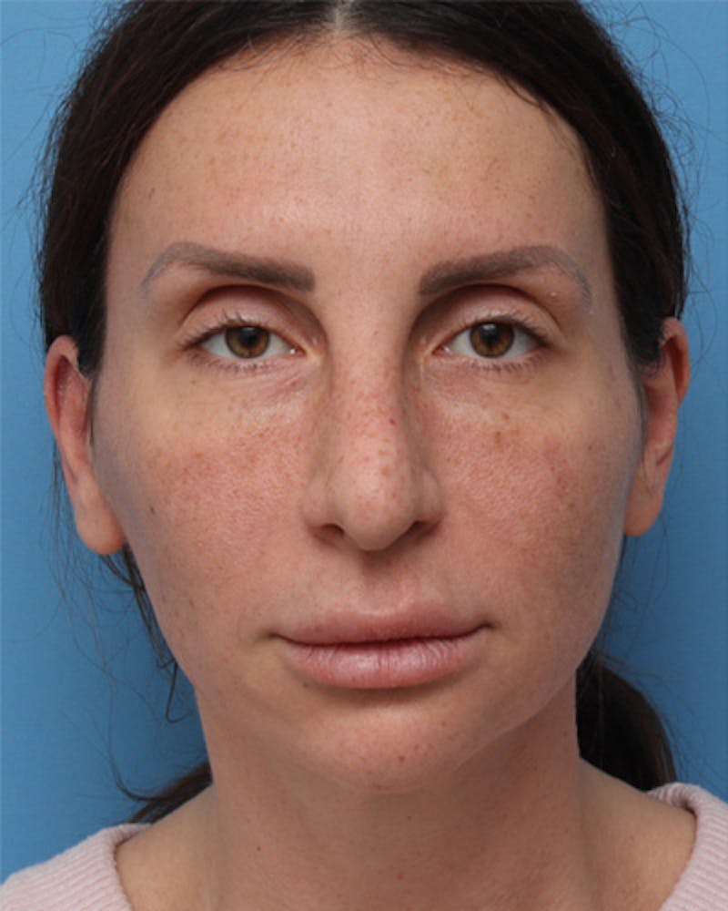 Revision Rhinoplasty Before & After Gallery - Patient 180542 - Image 3
