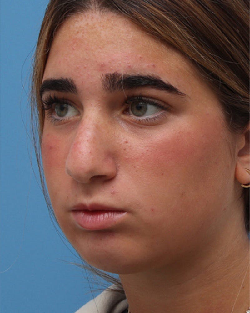 Rhinoplasty Before & After Gallery - Patient 345096 - Image 3