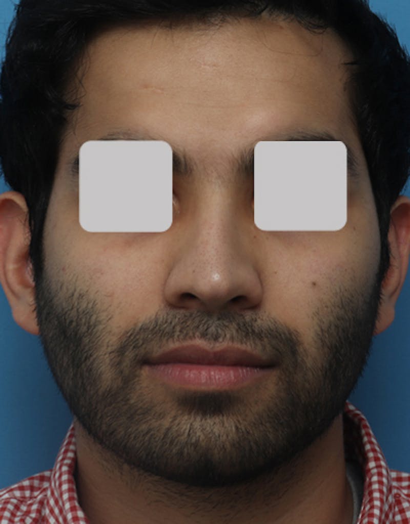 Ethnic Rhinoplasty Before & After Gallery - Patient 346298 - Image 4