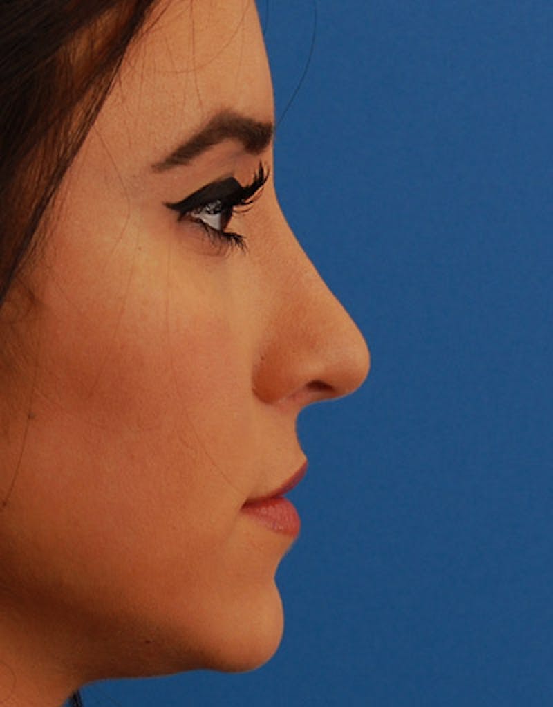 Foundation Rhinoplasty / Crooked Nose Before & After Gallery - Patient 274082 - Image 4