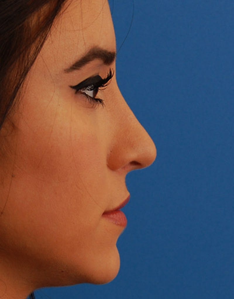 Rhinoplasty  Before & After Gallery - Patient 104959 - Image 4