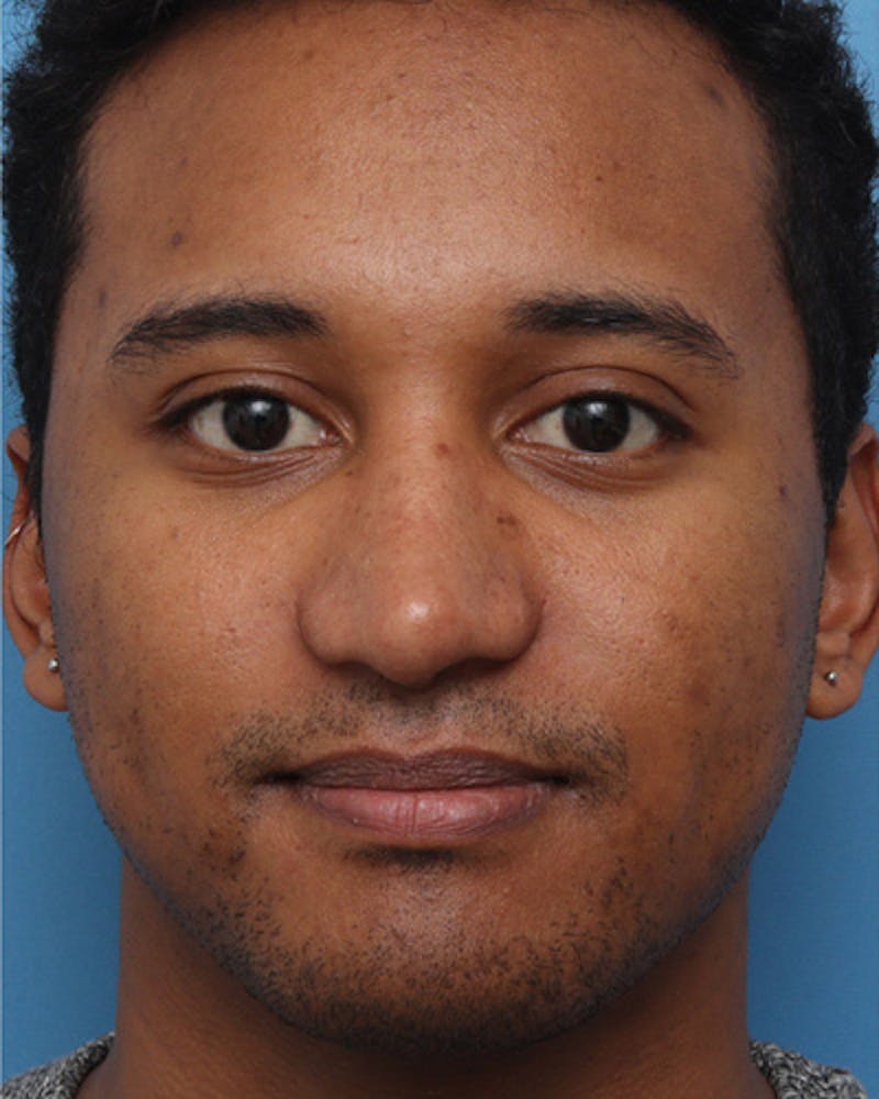 Male Rhinoplasty Before & After Gallery - Patient 279795 - Image 4