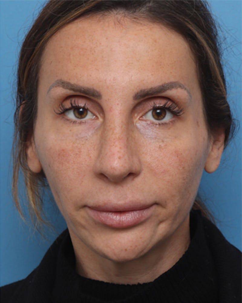 Revision Rhinoplasty Before & After Gallery - Patient 180542 - Image 4