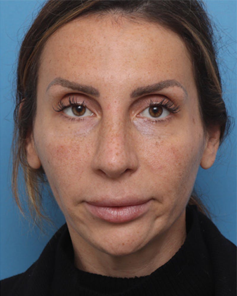 Rhinoplasty  Before & After Gallery - Patient 123643 - Image 4