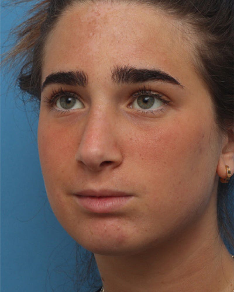 Rhinoplasty Before & After Gallery - Patient 345096 - Image 4