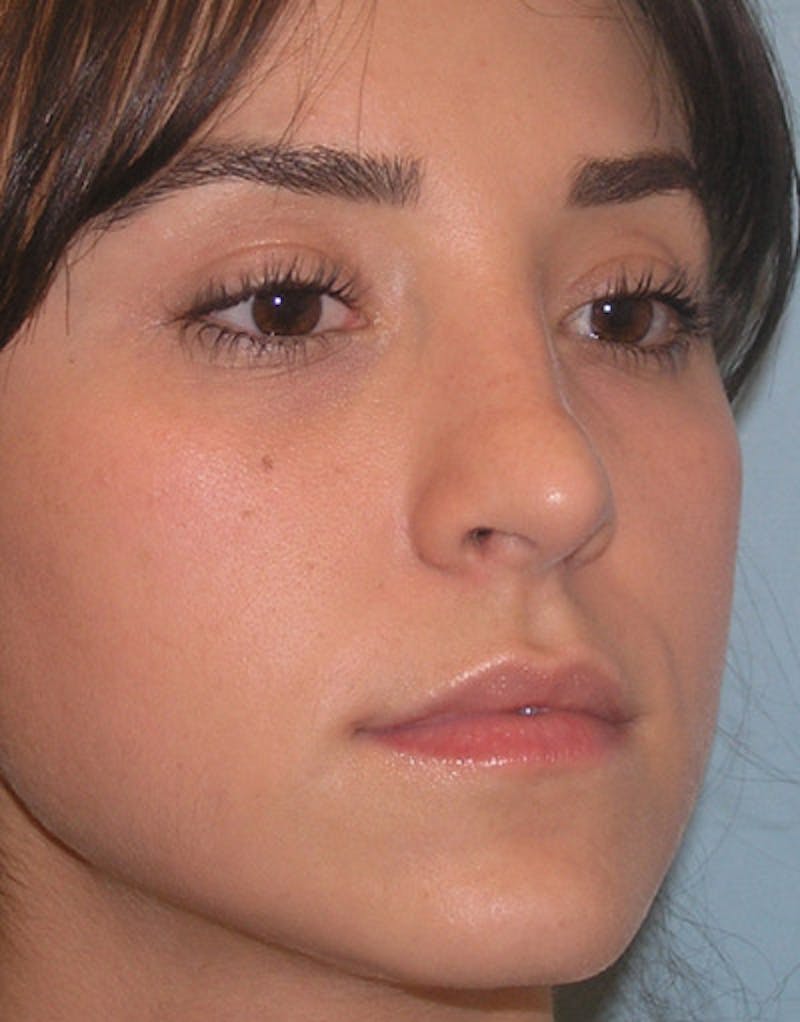 Foundation Rhinoplasty / Crooked Nose Before & After Gallery - Patient 274082 - Image 5