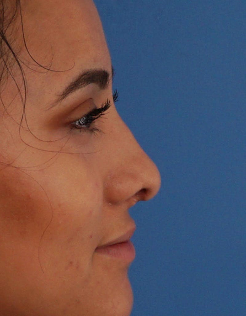 Ethnic Rhinoplasty Before & After Gallery - Patient 169262 - Image 1