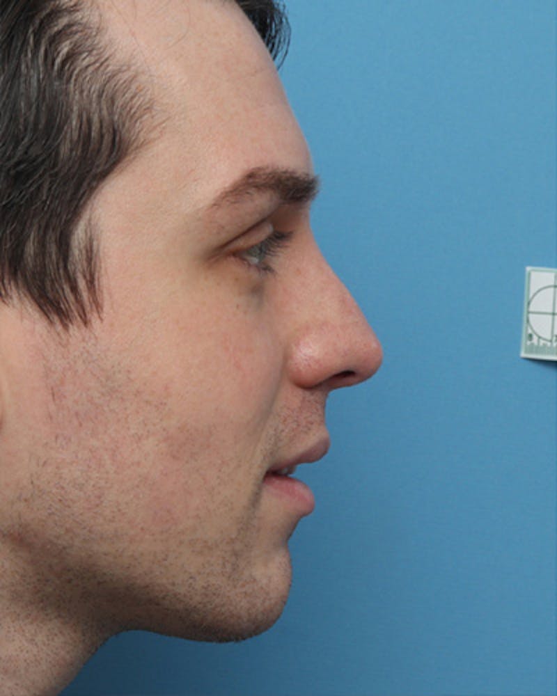 Male Rhinoplasty Before & After Gallery - Patient 330457 - Image 1