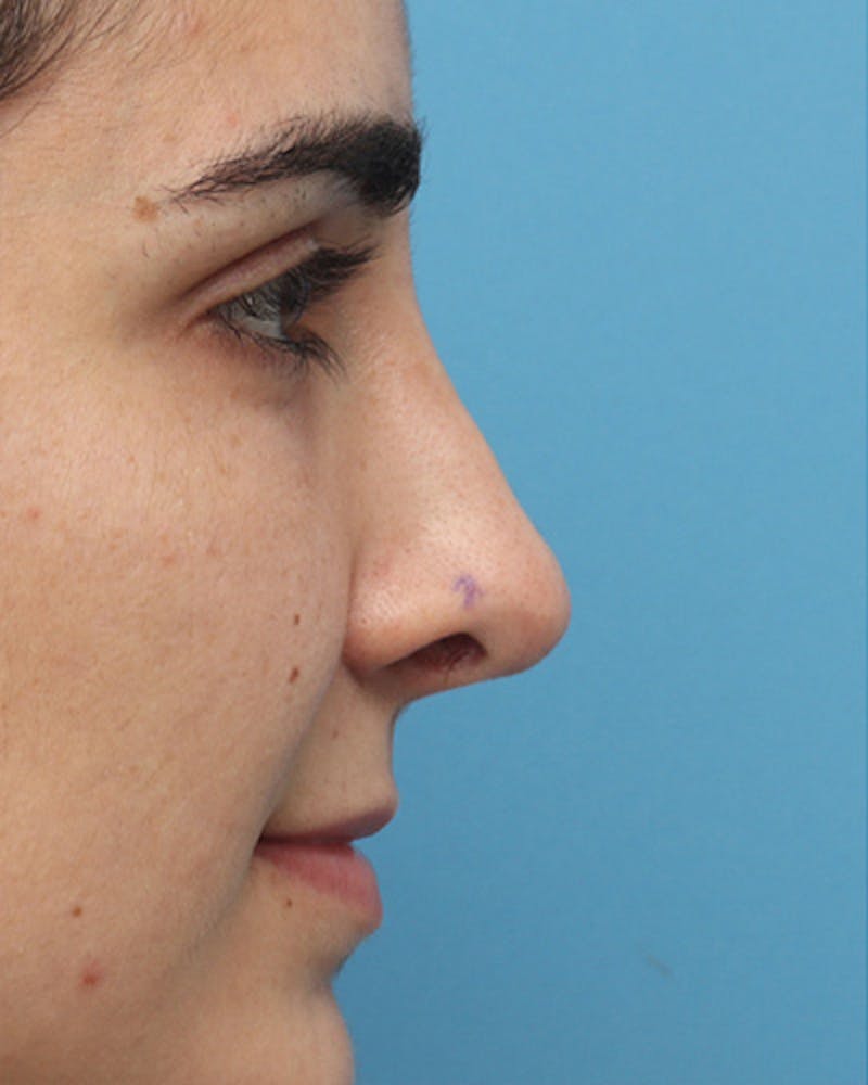 Revision Rhinoplasty Before & After Gallery - Patient 756844 - Image 1