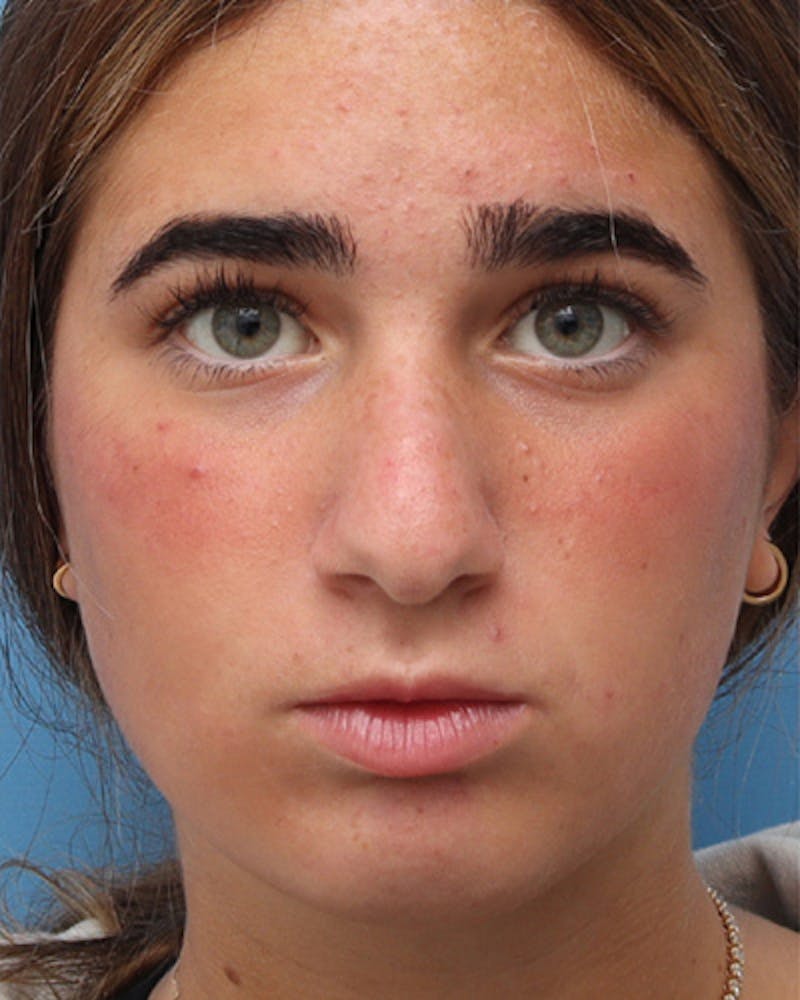 Rhinoplasty Before & After Gallery - Patient 345096 - Image 5