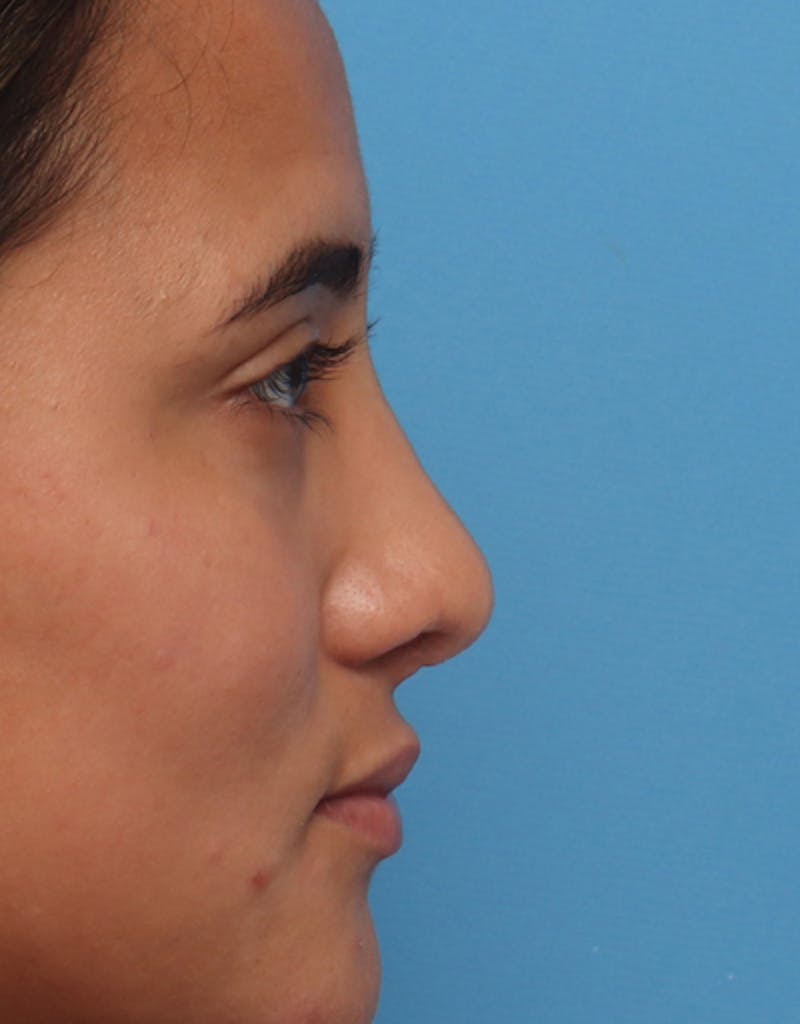Ethnic Rhinoplasty Before & After Gallery - Patient 169262 - Image 2