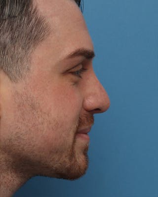 Rhinoplasty Before & After Gallery - Patient 420647 - Image 2