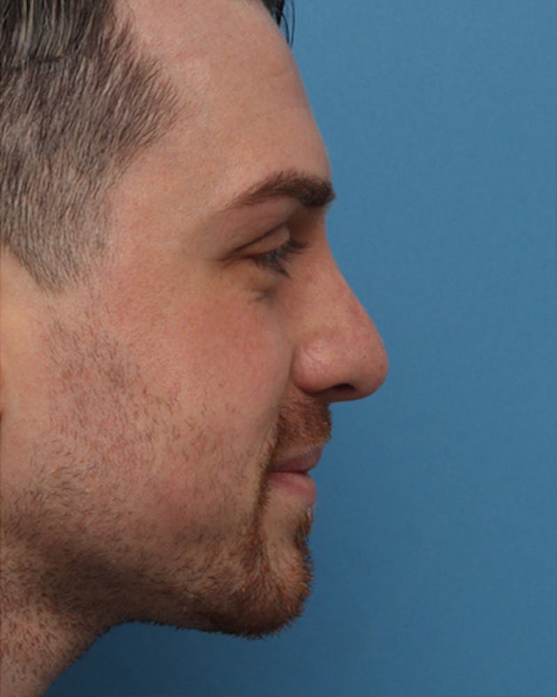 Male Rhinoplasty Before & After Gallery - Patient 330457 - Image 2
