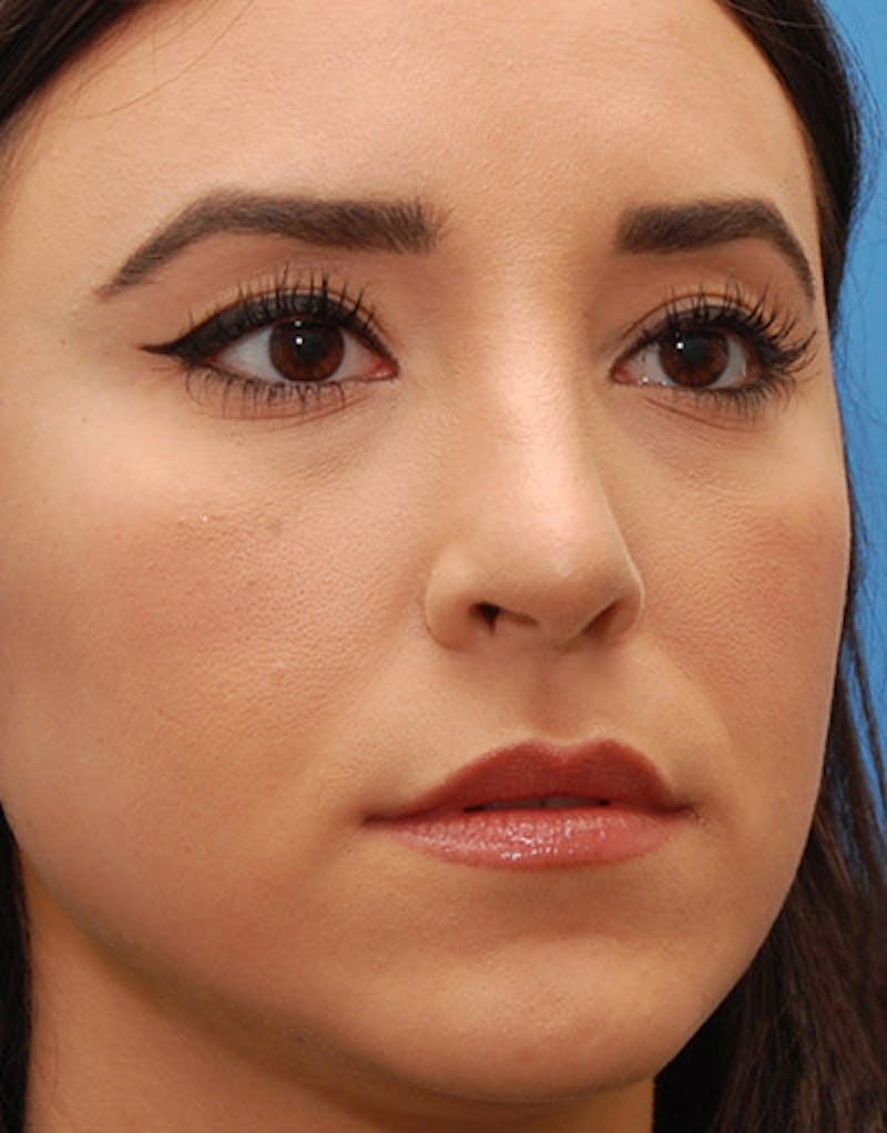 Foundation Rhinoplasty / Crooked Nose Before & After Gallery - Patient 274082 - Image 6
