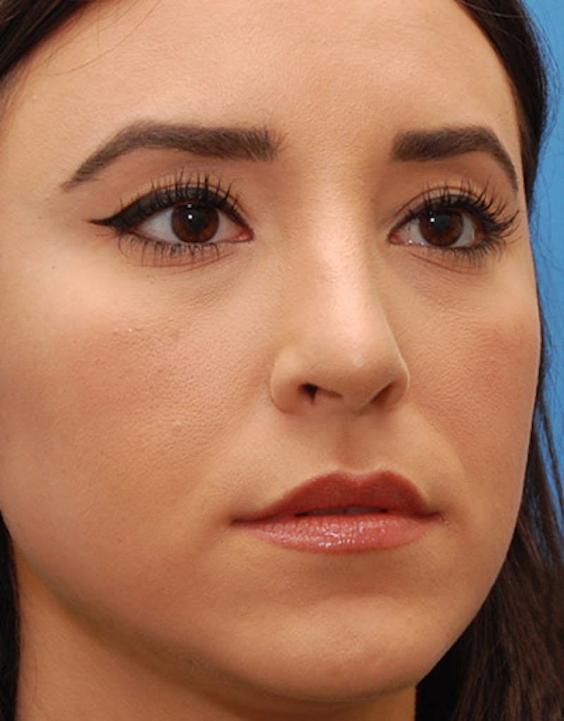 Rhinoplasty  Before & After Gallery - Patient 104959 - Image 6