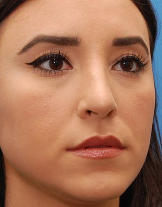 Rhinoplasty Before & After Gallery - Patient 104959 - Image 6