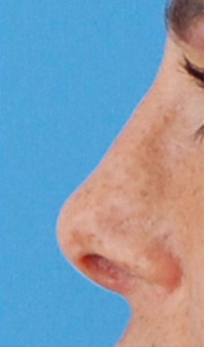 Non-Surgical Rhinoplasty Before & After Gallery - Patient 152731 - Image 2