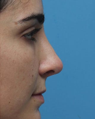Rhinoplasty Before & After Gallery - Patient 270387 - Image 2