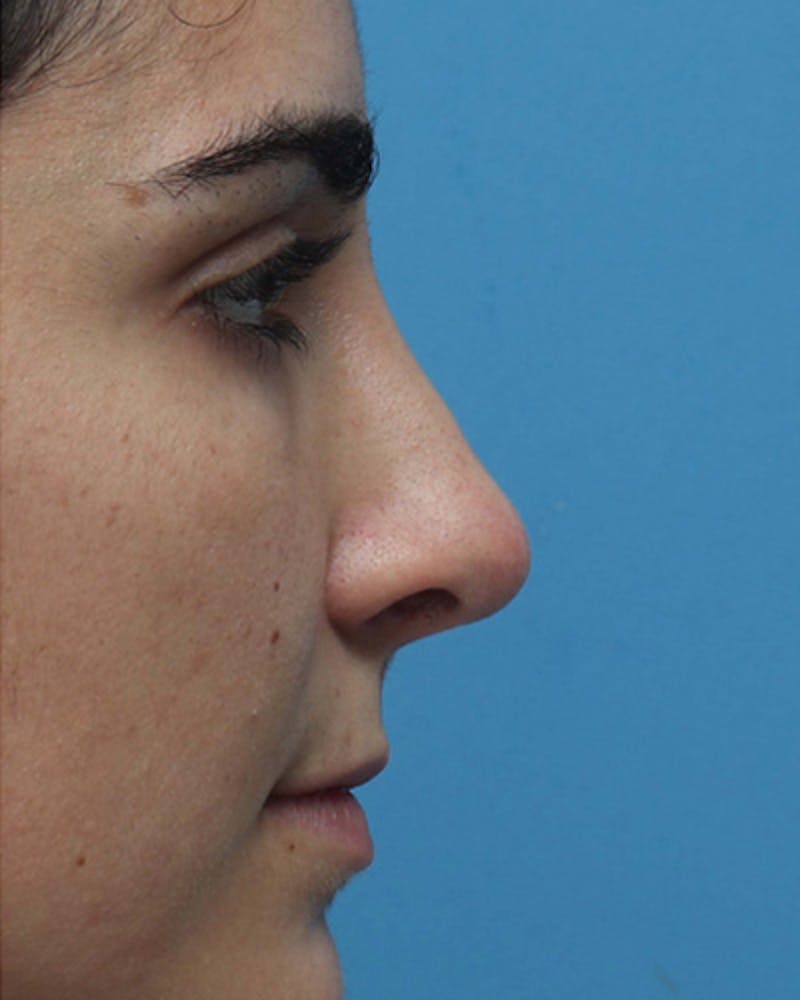 Revision Rhinoplasty Before & After Gallery - Patient 756844 - Image 2