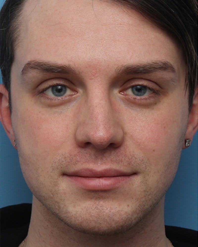 Male Rhinoplasty Before & After Gallery - Patient 330457 - Image 3
