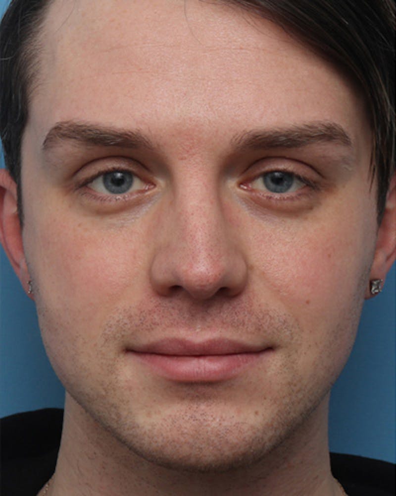 Rhinoplasty  Before & After Gallery - Patient 420647 - Image 3