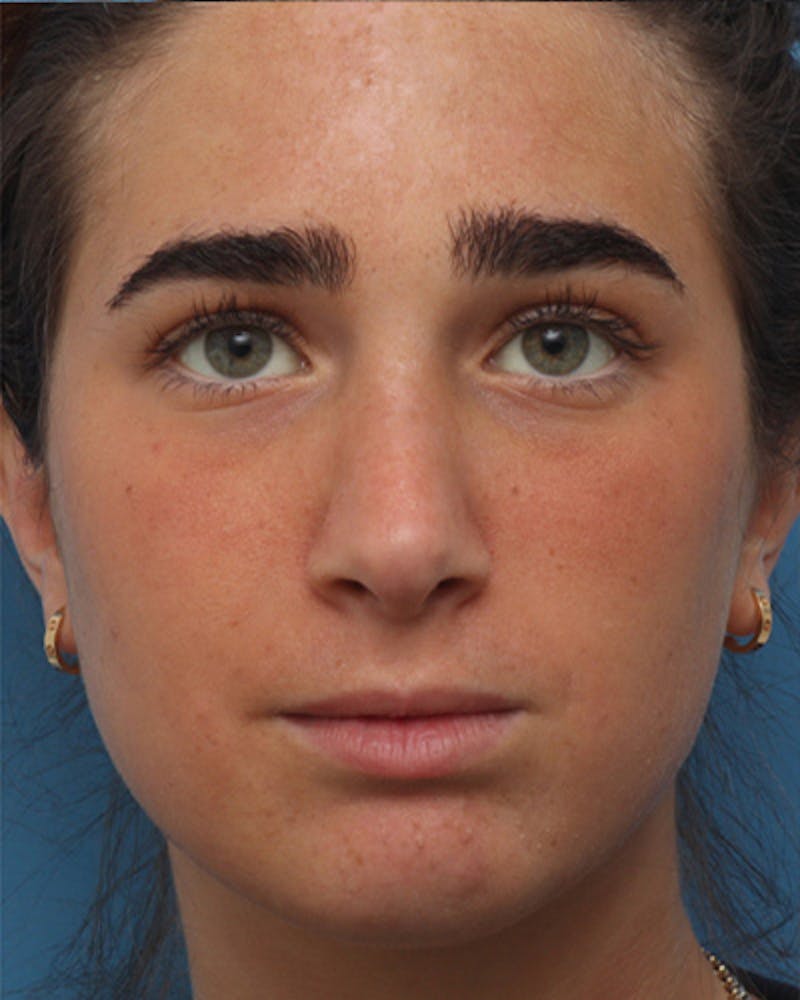 Rhinoplasty Before & After Gallery - Patient 345096 - Image 6