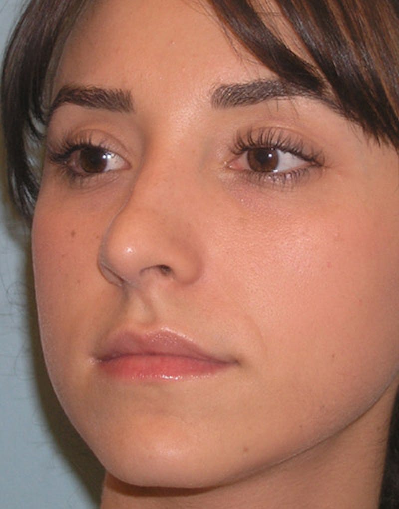 Foundation Rhinoplasty / Crooked Nose Before & After Gallery - Patient 274082 - Image 7