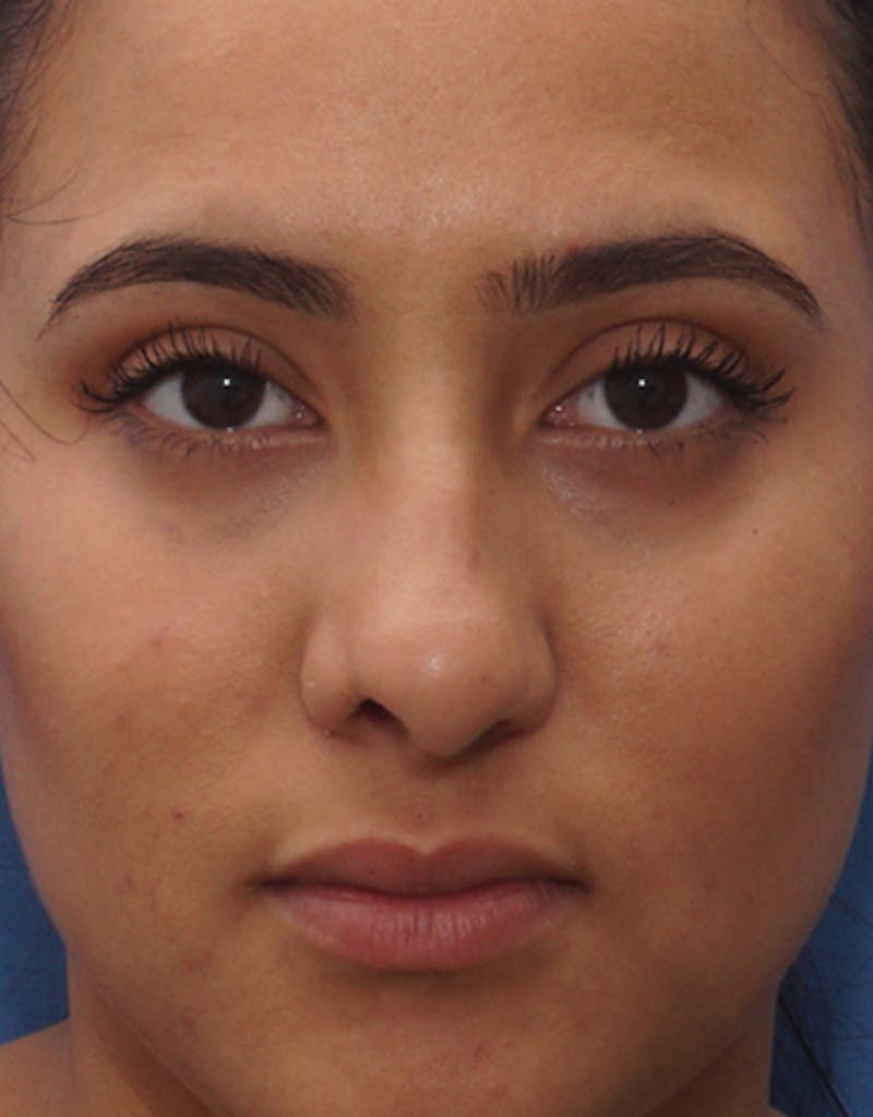 Ethnic Rhinoplasty Before & After Gallery - Patient 169262 - Image 3