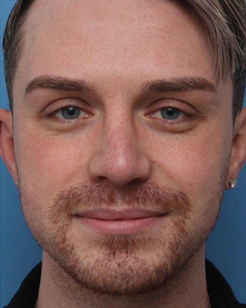 Male Rhinoplasty Before & After Gallery - Patient 330457 - Image 4