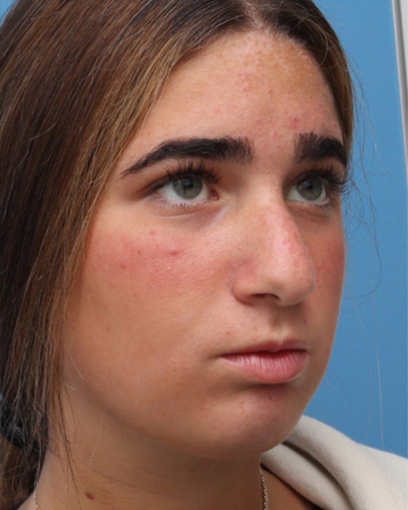 Rhinoplasty Before & After Gallery - Patient 345096 - Image 7