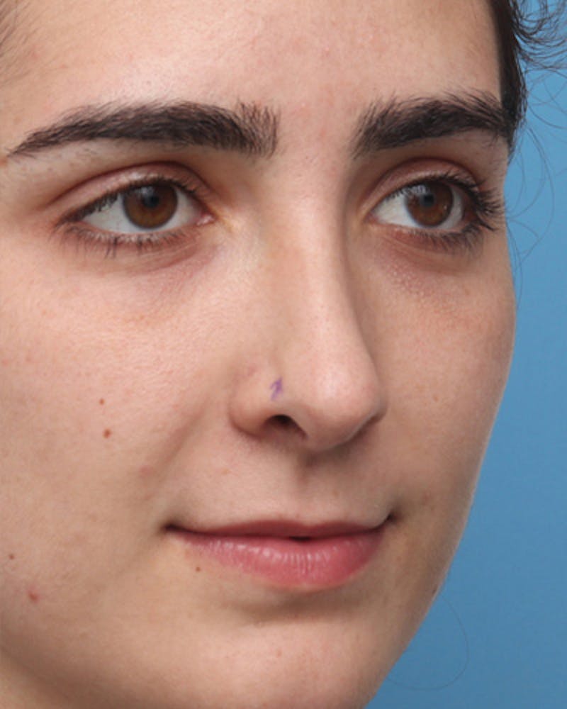Revision Rhinoplasty Before & After Gallery - Patient 756844 - Image 3