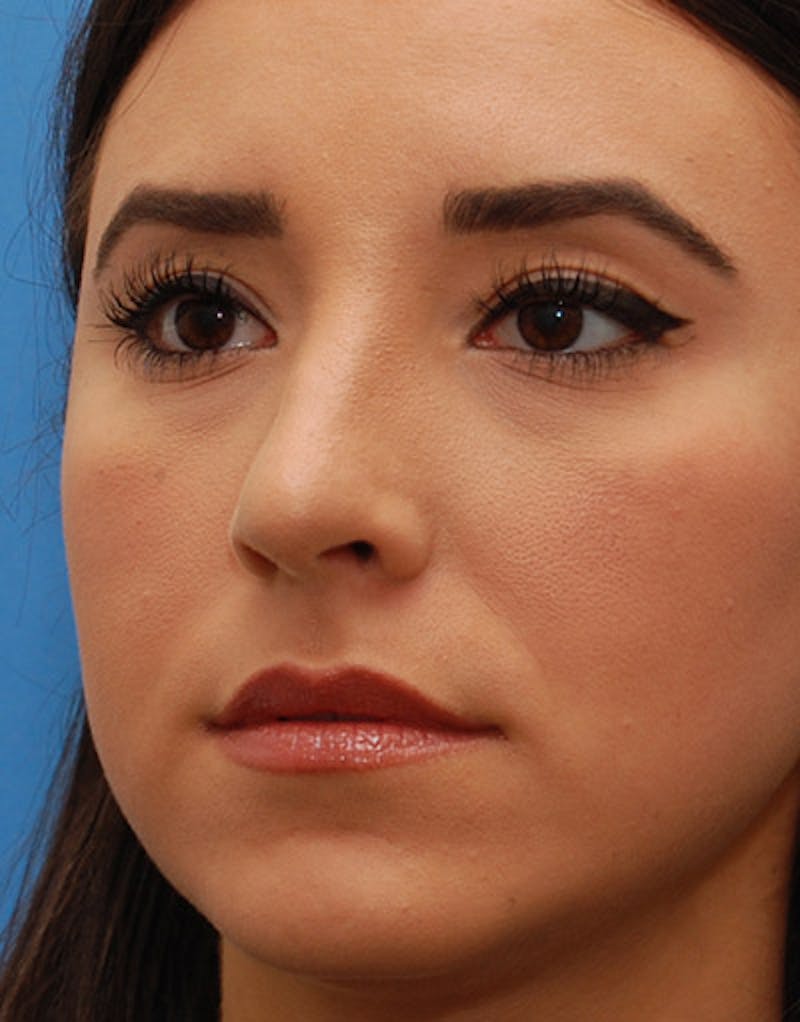 Foundation Rhinoplasty / Crooked Nose Before & After Gallery - Patient 274082 - Image 8