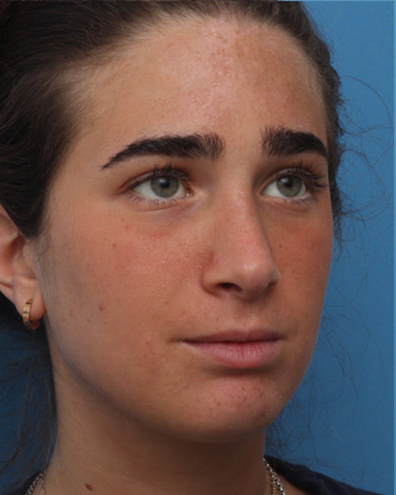 Rhinoplasty Before & After Gallery - Patient 345096 - Image 8