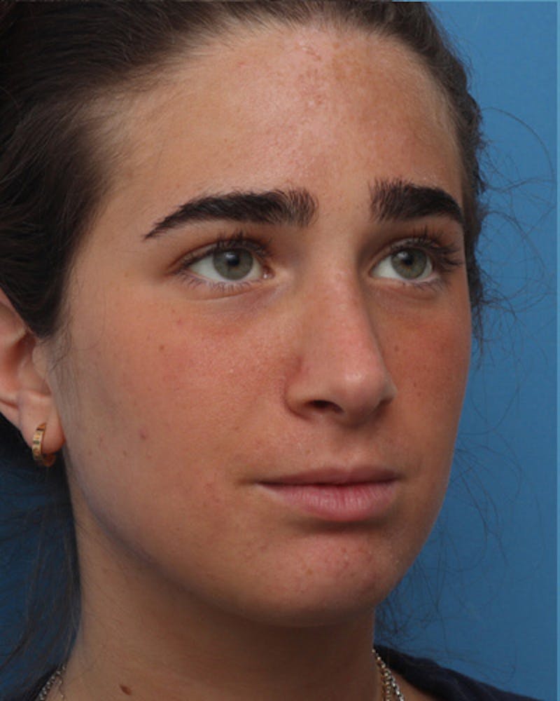 Rhinoplasty  Before & After Gallery - Patient 360831 - Image 8