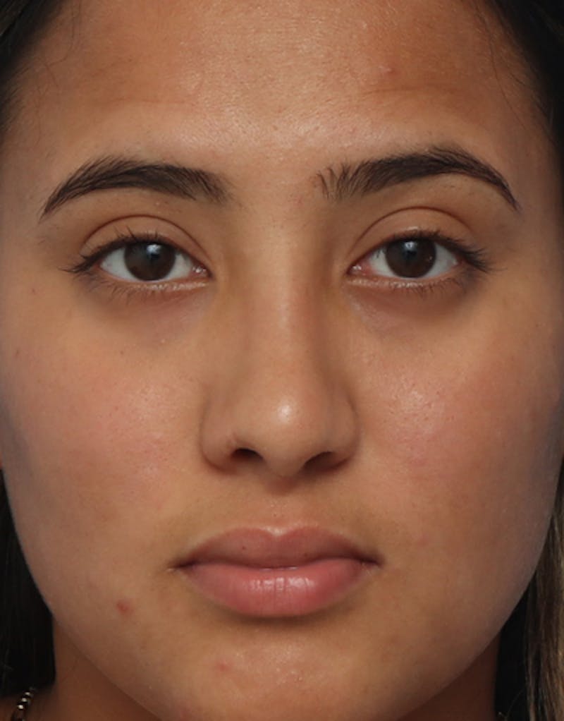 Ethnic Rhinoplasty Before & After Gallery - Patient 169262 - Image 4