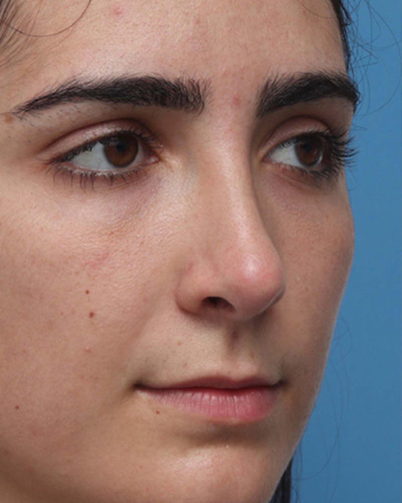Revision Rhinoplasty Before & After Gallery - Patient 756844 - Image 4