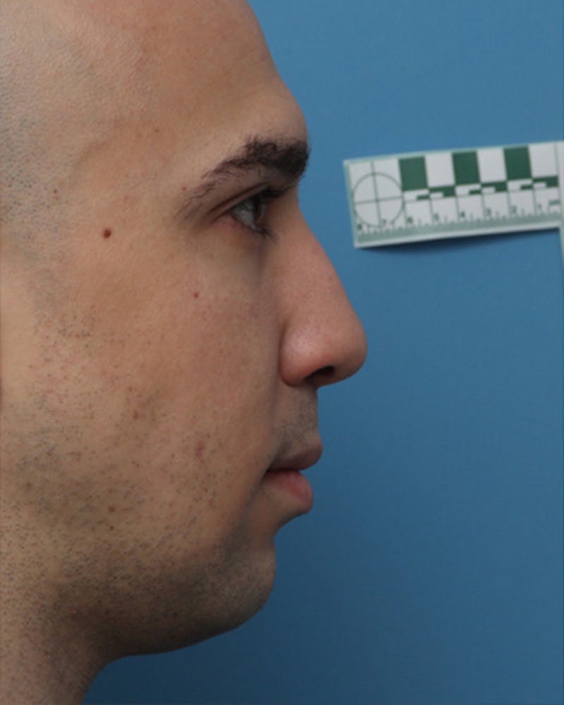 Male Rhinoplasty Before & After Gallery - Patient 908208 - Image 1