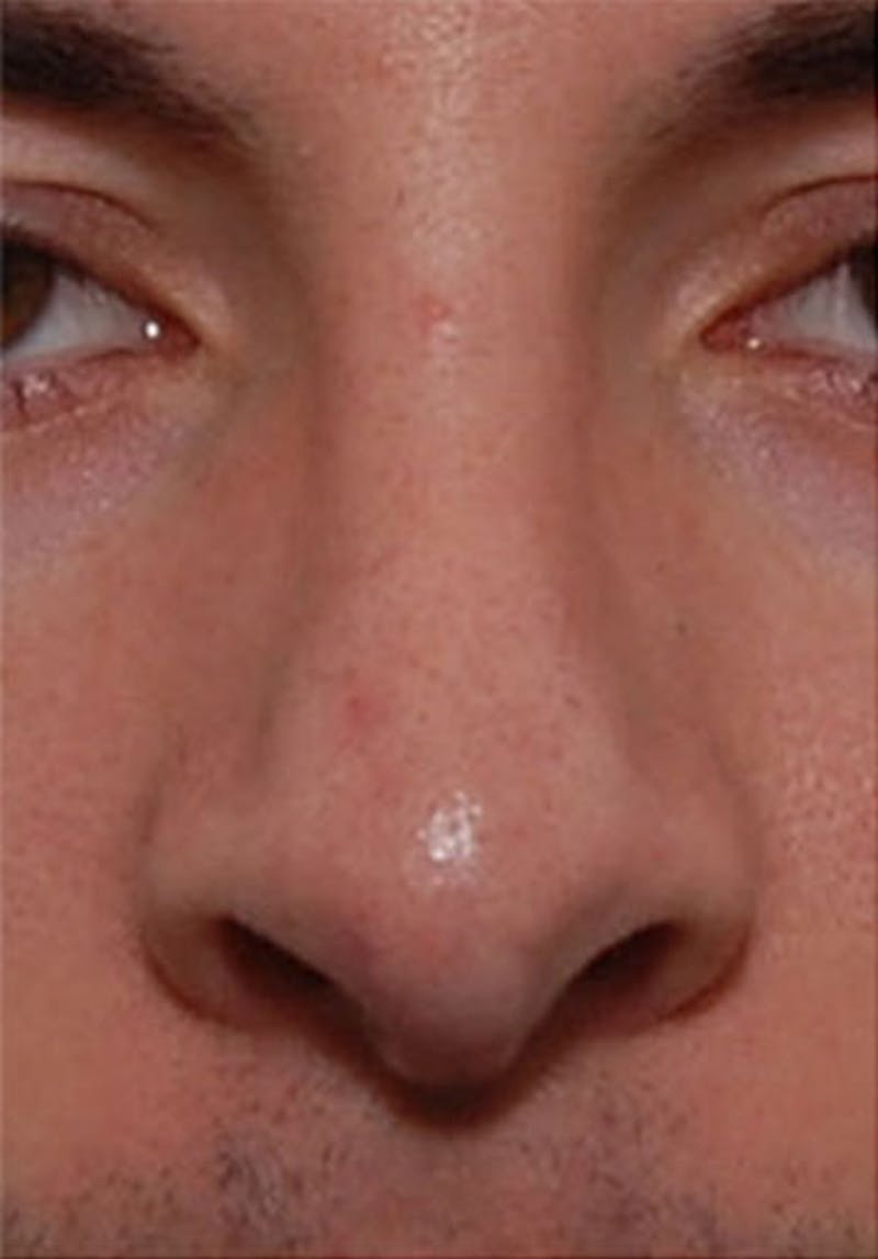 Patient QffuXlaYSBuiPjl1nlW5zQ - Non-Surgical Rhinoplasty Before & After Photos