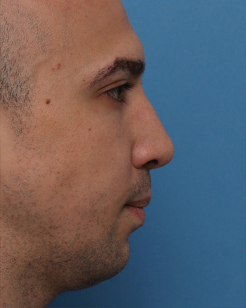 Male Rhinoplasty Before & After Gallery - Patient 908208 - Image 2