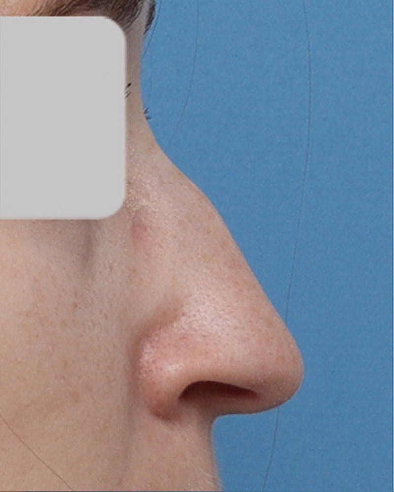 Rhinoplasty Before & After Gallery - Patient 363555 - Image 1