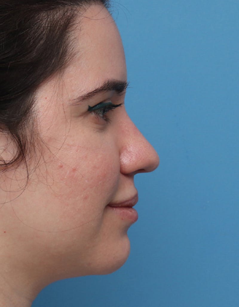 Ethnic Rhinoplasty Before & After Gallery - Patient 147895 - Image 1