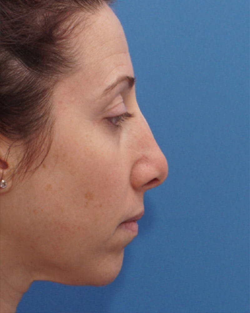 Revision Rhinoplasty Before & After Gallery - Patient 573914 - Image 1